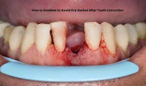 Image result for Tooth Extraction