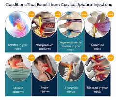 Image result for Lower Cervical Intramuscular Injection