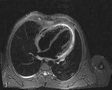 Neben dem ekg kann auch eine magnetresonanztomografie (mrt) mit kontrastmittel aufschluss über entzündete herzareale geben. Kardio Mrt Dr Thomas Hafner Kardiologe Und Internist Wien Wahlarzt Kfa Und Privat