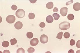 Image result for Peripheral Smear