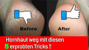 Hornhaut stellt im normalfall kein medizinisches problem dar. 5 Erprobte Tricks Um Extreme Hornhaut Zu Entfernen Youtube