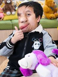 Bhutan boy Sidath transformed by Adelaide surgeon in complex operation