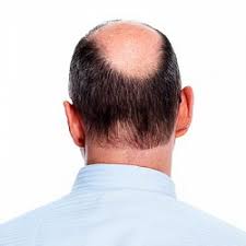 Neither clonidine or micardis have ever been linked to hair loss in females or males. How Is A Low High Blood Pressure Related To Hair Loss Ahs India