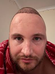 One woman woke up botched and learned a hard lesson about experimenting  with cosmetic procedures. Video in the comments. Image: Berthecn/ TikTok