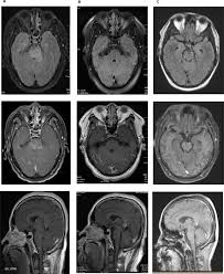 Magnetic resonance imaging (mri) of the brain revealed diffuse signal change within the pons, cerebellar peduncles and pontomedullary junction with some mass effect, and characteristic punctate. Clippers A Syndrome Of Lymphohistiocytic Disorders Multiple Sclerosis And Related Disorders
