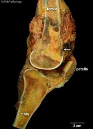 Image result for Osteosarcoma