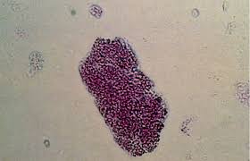 Image result for Urinary Cast