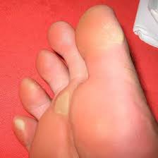 We did not find results for: Symptoms And Treatment For Corns And Calluses