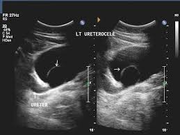 Ultrasound Image Gallery Interventional Radiology Ultrasound Bladder