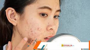 Penyebab Jerawat di Dagu dan Tips Mengatasinya