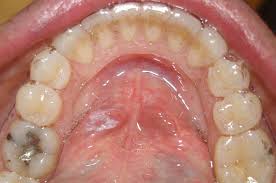 Some contain a brief patient history which may add insight to the actual diagnosis of the disease. Self Oral Cancer Screening Socs Education Program School Of Dentistry Lsu Health New Orleans
