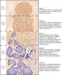 With stage 4 gleason score 9 bi opcy positive. Prostate Cancer Oncology Internal Medicine Correlations And Clinical Scenarios Ccs Usmle Step 3