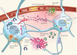 Alzheimer S Terapia Da Fala Terapia