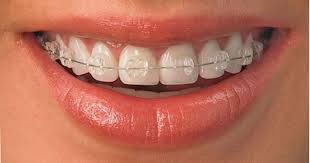 What You Need To Know About Braces And Orthodontics Clear Braces Dental Braces Ceramic Braces