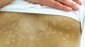 Ketoconazole cream is used to treat: Tinea Versicolor Causes Symptoms Treatment