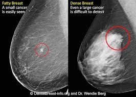 You may also have breast exams. Mammography 3d Mammography Tomosynthesis Densebreast Info Inc