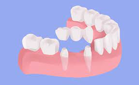 The Process Used To Replace Missing Teeth Is A Dental Bridge Which Attaches Artificial Teeth Adjacent To Your Nat Dental Bridge Dental Bridge Cost Tooth Repair