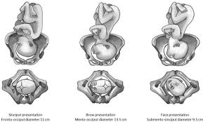 Image result for Brow Presentation