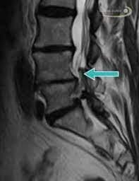Unter der spondylitis versteht man die entzündliche erkrankung der wirbelsäule. Wirbelsaulenarthrose Facettengelenksarthrose Verursacht Ruckenschmerzen Gelenk Klinik De