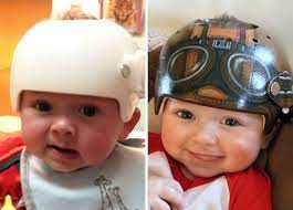 Artist Transforms Babies Head Shaping Helmets Into Beautiful Art Bored Panda