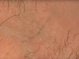 Ingrown hairs can appear in a number of ways. The Best Ingrown Hair Removal Videos Insider