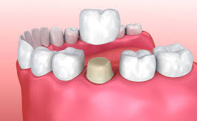 Last night i fell and chipped 3 of my teeth kind of badly and i was wondering what the ballpark price is for that with insurance. How Much Do Dental Crowns Usually Cost Los Angeles Dental Crown Replacement Cost