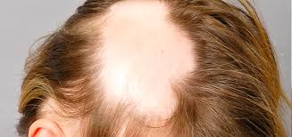 It is otherwise referred… by greenrun. Treatment Of Alopecia Areata Universalis Cubaheal