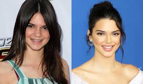 Maybe you would like to learn more about one of these? Celebrities With Braces Before And After Famous Brace Faces