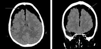 Cureus Tension Pneumocephalus In A Tracheostomized Chronically Ventilated Duchenne S Muscular Dystrophy Patient Without Prior Head Trauma