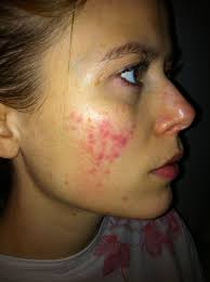 Résultat de recherche d'images pour "rosacea"