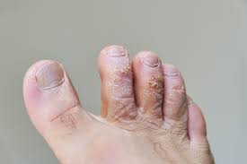 Image result for mykoza nehtů