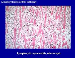 There are no microscopic, immunological, or histochemical markers that can confirm a diagnosis of dcm. L31 Pathology Of Myocardial Disease Flashcards Quizlet