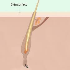 Hair removal day spas skin care. How Laser Hair Removal Works Tempe Arizona Hello Laser