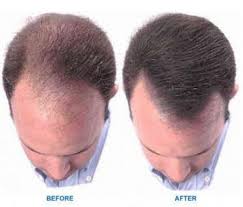 But when your hairline is receding, and you can see your scalp where your hair is thinning, it's also normal to feel distressed. Minoxidil For Receding Hairline Treatment Cool Men S Hair