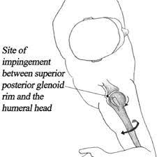 Internal Impingement The Tendon Of The Rotator Cuff Becomes Compressed Download Scientific Diagram