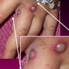 Presently, no treatment for monkeypox is safe or effective. What Is Monkeypox And What Are The Symptoms Person In England Diagnosed With Condition Chronicle Live