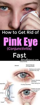 How To Get Rid Of Pink Eye Conjunctivitis Fast Pink Eyes Bacterial Pink Eye Pinkeye Remedies
