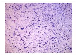 Image result for Leiomyosarcoma