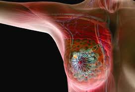 More than likely, the culprit is a skin condition. Breast Cancer Awareness Symptoms Diagnosis And Treatment