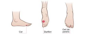 Afin d'adapter le traitement de l'oeil de perdrix, il est important de connaître son stade : Cors Au Pied Comment S En Debarrasser Pied Zen