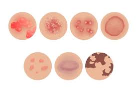 نشانه های پوستی بیماری ها - خورشیدفران ایرانیان زمین