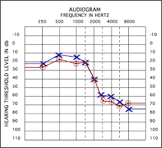 Understanding Your Audiogram