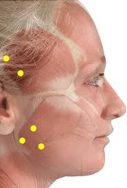 Injection sites of the botulinum toxin, 3 sites per masseter and 2 per...