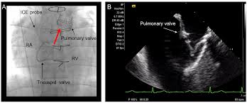 Comparison Of Pda Type Between Echocardiography And Angiography Showing...  | Download Scientific Diagram