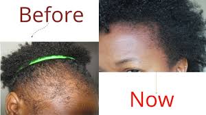 Hair units can be used for women also. Black Woman Alopecia All You Need To Know About The Hair Disease