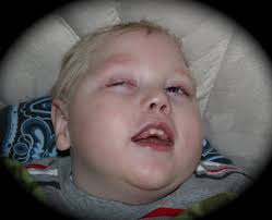 Carson Bowman Menkes Disease Story: 2010