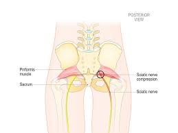 This may indicate an anterior pelvic tilt.3 x research source. Sciatica And Sciatic Nerve Pain Information