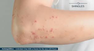 Image result for shingles in children