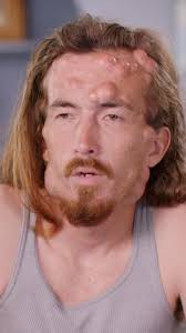 Kenny has a rare condition called Gardner syndrome and over 400 (!!!)  growths