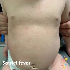 Image result for Scarlet Fever